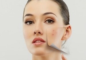 Adult Acne Treatment